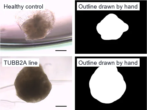 Brightfield microscope images of a brain organoid from a healthy control and one from a TUBB2A tubulinopathy line on day 30, each beside its outline drawn by hand, one lobed and one rounder.