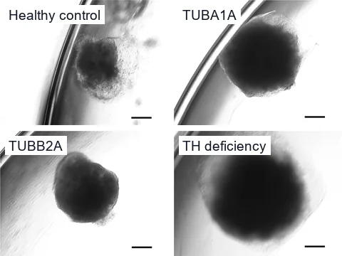 Brightfield microscope images of four brain organoids on day 30, one from each line: a healthy control and lines with TUBA1A tubulinopathy, TUBB2A tubulinopathy and tyrosine hydroxylase deficiency.