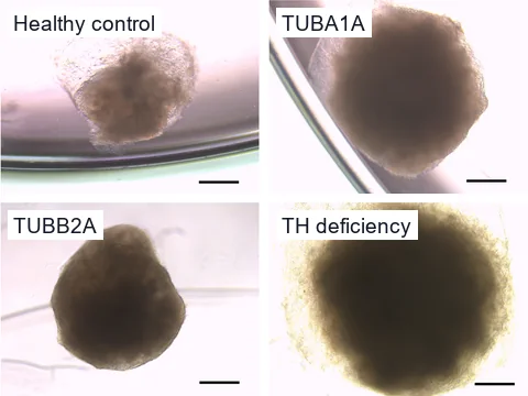 Brightfield microscope images of four brain organoids on day 30, one from each line: a healthy control and lines with TUBA1A tubulinopathy, TUBB2A tubulinopathy and tyrosine hydroxylase deficiency, each with a 500 µm scale bar.