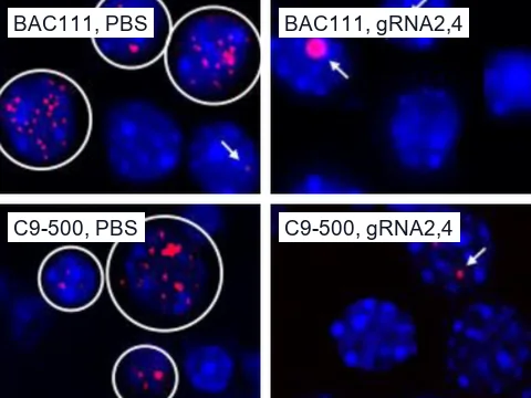 Fluorescence images of mouse primary neurons carrying the human C9orf72 repeat expansion, nuclei blue (DAPI) and sense repeat RNA foci red (FISH). Foci are many after PBS and few after excision with gRNA2,4.