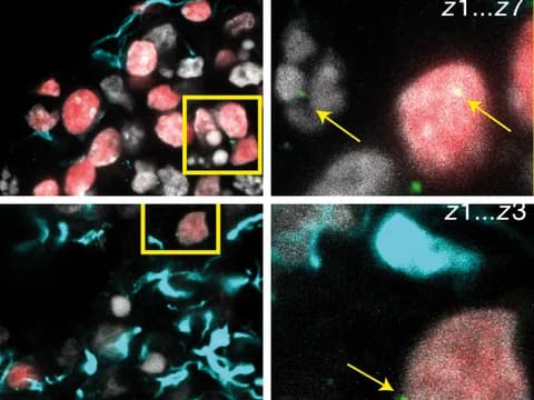 Fluorescence images of brain organoid slices from two C9orf72 lines, neuronal nuclei red (CTIP2), astroglia cyan (GFAP) and nuclei gray (DAPI). Insets show green poly(GA) dipeptide-repeat foci beside neuronal nuclei (arrows).