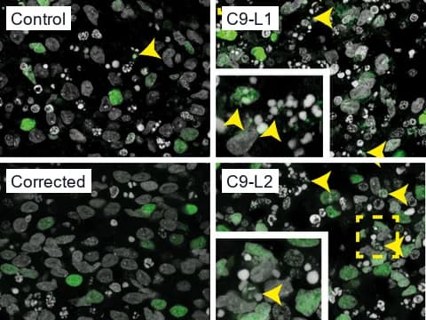 Fluorescence images of brain organoid slices with deep-layer neurons green (CTIP2) and nuclei gray (DAPI), two untreated controls and two C9orf72 lines. Yellow arrowheads and insets mark small, condensed pyknotic nuclei: one in the controls, several in each C9orf72 slice.