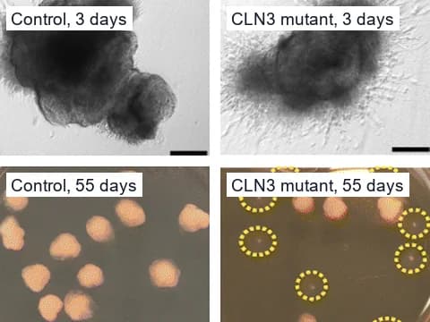 Brightfield microscope images of a control and a CLN3-mutant human cerebral organoid three days into differentiation, above dishes of control and mutant organoids after 55 days. The control has outgrowths, and small underdeveloped mutant organoids are circled in yellow.