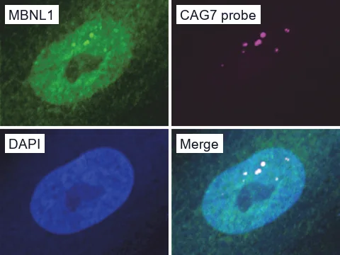 One DM1 fibroblast nucleus in four fluorescence channels: MBNL1 green (antibody 3E7), CUG repeat RNA foci magenta (CAG7 probe), DAPI blue, and the merge, where bright MBNL1 spots overlap the RNA foci.
