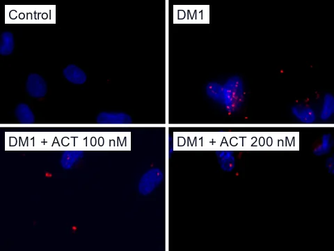 Four fluorescence images of neurons converted directly from skin fibroblasts, nuclei blue (DAPI) and CUG repeat RNA foci red (Texas red CAG probe). Control neurons show no foci, DM1 neurons many, and DM1 neurons after 100 nM or 200 nM actinomycin D fewer.