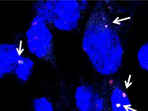 Fluorescence image of neurons made from DM2 stem cells, with nuclei blue, CCUG repeat RNA foci red (FISH) and MBNL1 green. Arrows mark foci co-stained for MBNL1 inside nuclei.