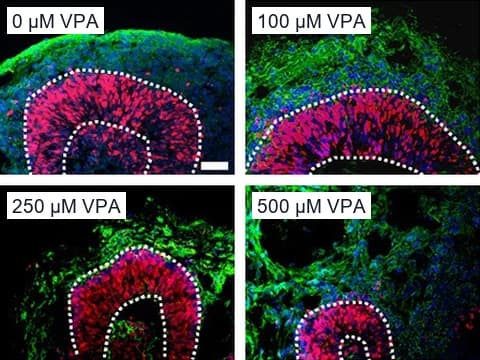 Fluorescence images of sections of four human dorsal forebrain organoids on day 56 after 0, 100, 250 or 500 µM valproic acid, stained for SOX2 (red) and DCX (green). White dotted lines mark the SOX2-positive layer, which is thinner at 250 and 500 µM.
