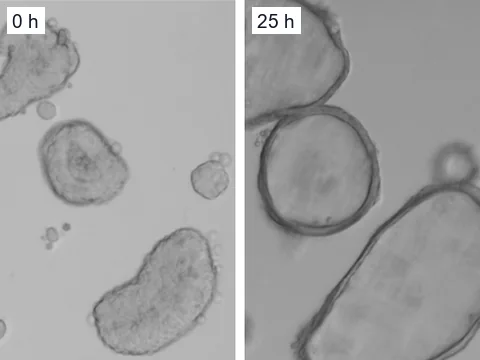 Microscope images of patient-derived intestinal organoids with a rare CFTR genotype when CFTR modulators were added and 25 hours later, an hour after forskolin, when their lumens had swollen.