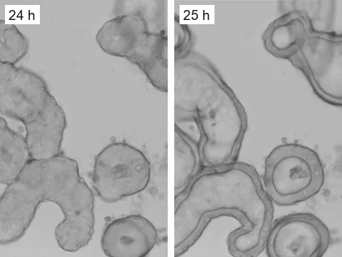 Microscope images of the same patient-derived intestinal organoids when forskolin was added and one hour later, when their lumens had filled with fluid.