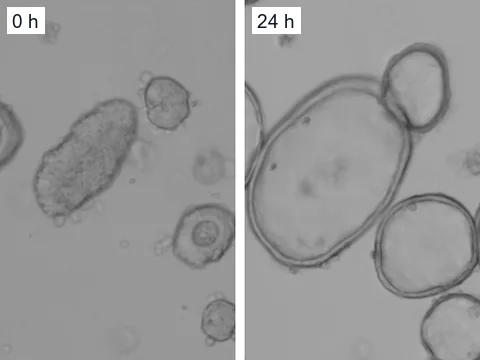 Microscope images of patient-derived intestinal organoids with a rare CFTR genotype when CFTR modulators were added and 24 hours later, when their lumens had filled with fluid.