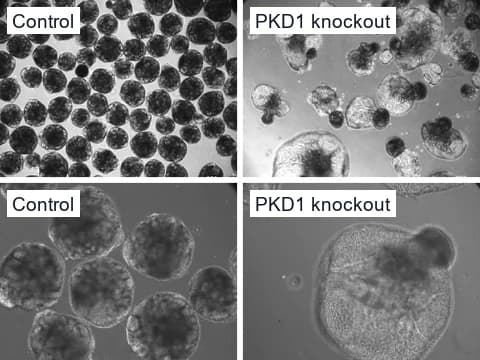 Microscope images of control kidney organoids, dense and round, beside PKD1 knockout organoids, many swollen into translucent cysts, at two magnifications.