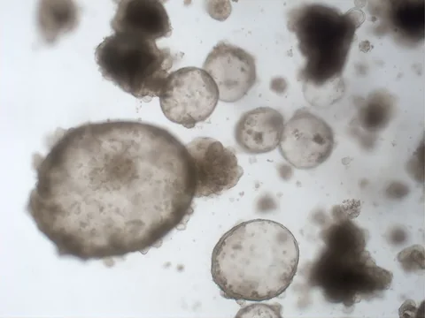 Brightfield image of rectal cancer organoids from one line, a large, pale, hollow organoid beside smaller ones that are solid and dark.