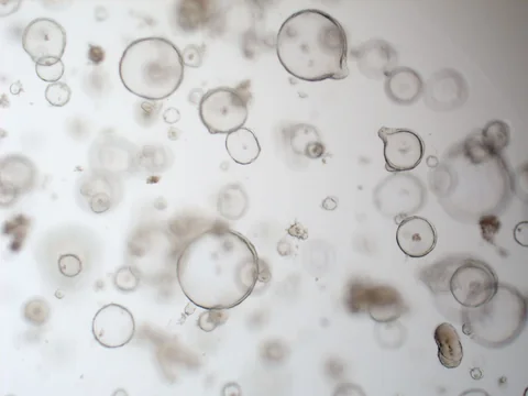 Brightfield image of rectal cancer organoids from one line, most of them hollow and of many sizes, some sharp and others out of focus.