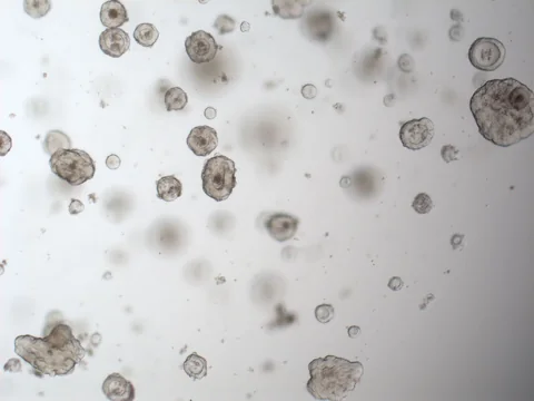 Brightfield image of rectal cancer organoids of varied sizes, most of them solid and rounded, a few large and irregular, and others out of focus at different depths.