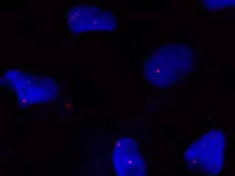 Corneal endothelial cell nuclei (blue, Hoechst) from a person with Fuchs endothelial corneal dystrophy and an expanded TCF4 repeat. Most nuclei hold one or two small red CUG repeat RNA foci (Cy3-(CAG)10 probe).