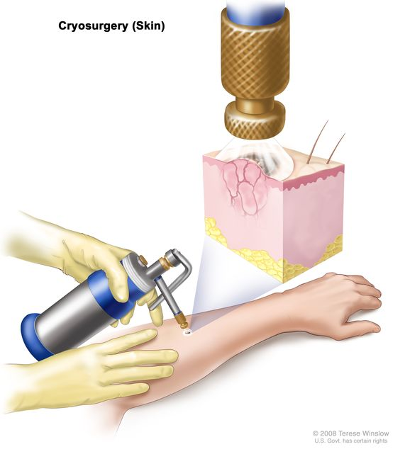 An illustration of cryoablation procedure on skin