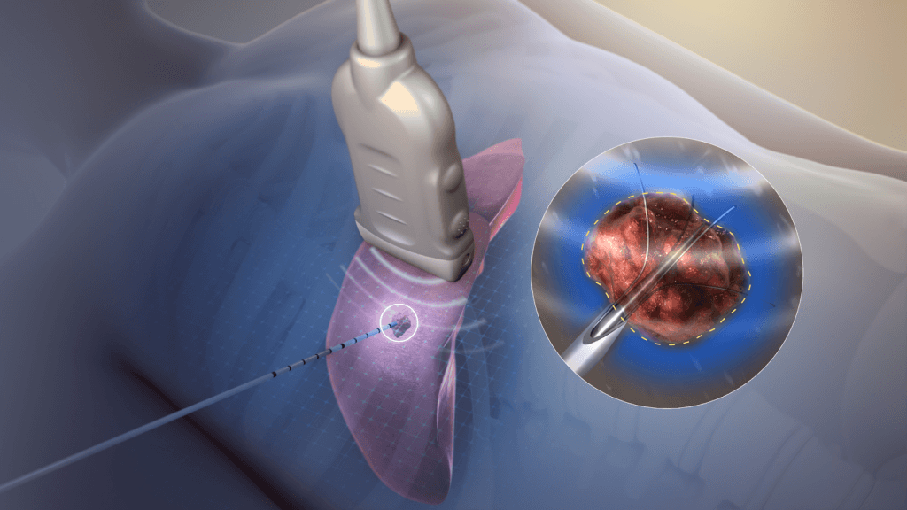 An illustration of electric current (produced by radiofrequency) ablating tumor tissues