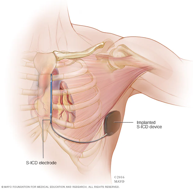 An illustration of implantation of a Subcutaneous implantable cardioverter-defibrillator (S-ICD) device just underneath the armpit on the side of the chest
